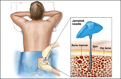 Procedures of Bone Marrow Examination