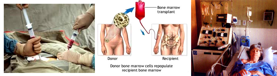 Bone Marrow Transplantation