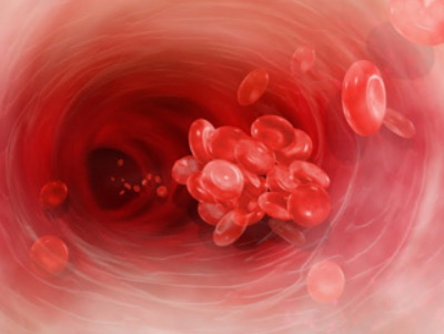 Haemophilia