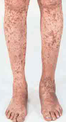 Platelet Disorders