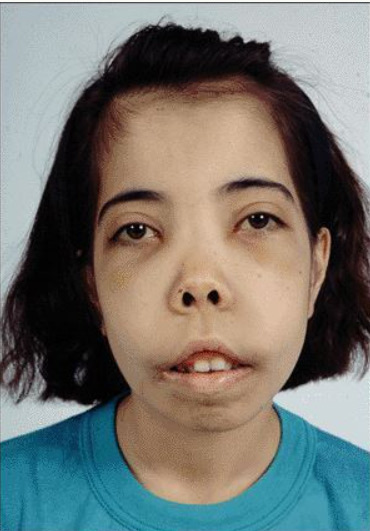 Thalassemia